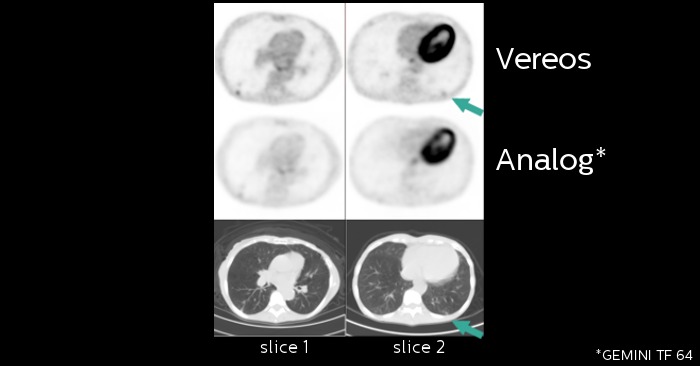 Improved detectability & characterization of small lesions with digital PET