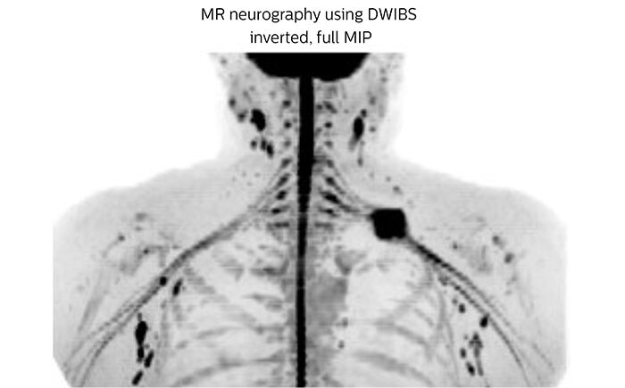 MR neurography using DWIBS inverted, full MIP