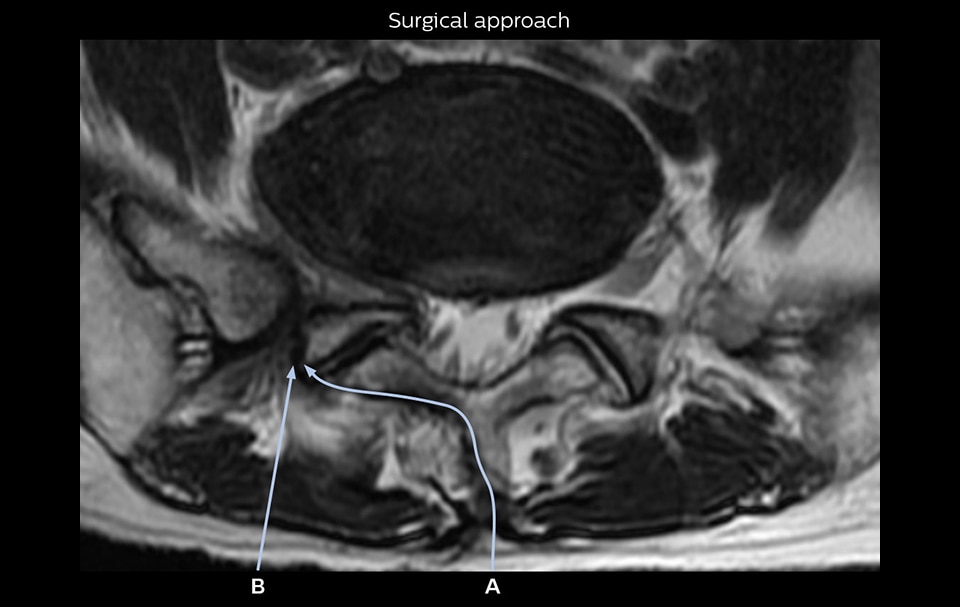 Nerveview surgical approach