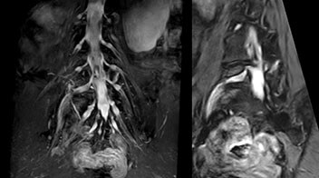 NFMC L5 radiculopathy NerveVIEW