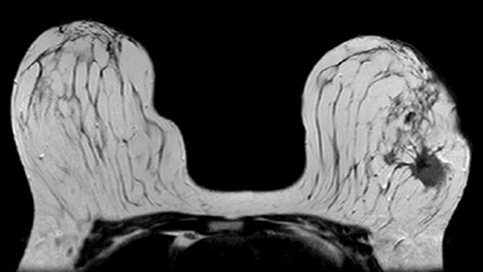 MRI of patient with invasive ductal carcinoma