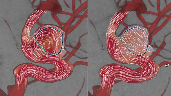 Aneurysm flow post treatment