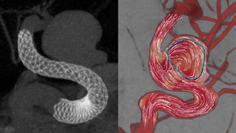 AneurysmFlow blood flow patterns visualization