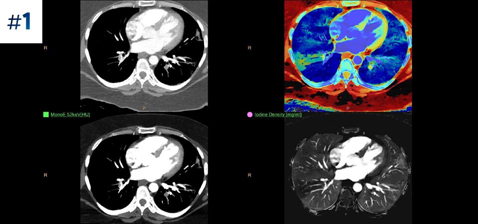 Torace, pentru depistarea embolismului pulmonar (PE)