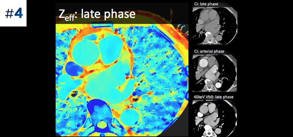 Apendicele atrial stâng