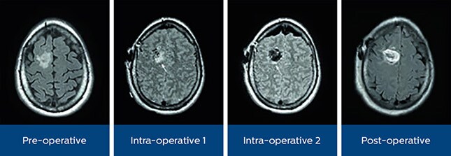 astrocytoma mr or
