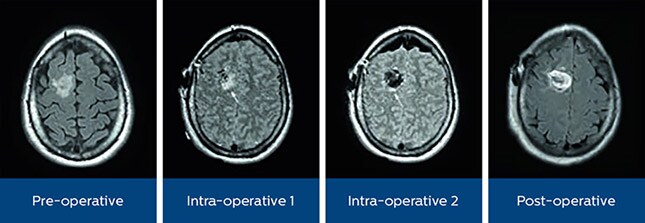 astrocytoma mr or