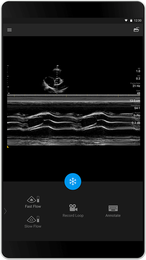 Badanie echokardiograficzne S4-1