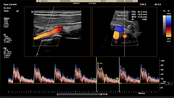 Example of an image retrieved with xPlane Doppler vascular ultrasound Philips