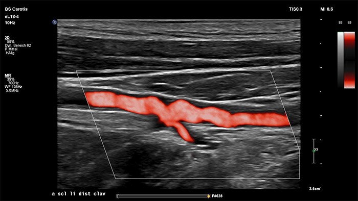 Image with MicroFlow Imaging vascular ultrasound
