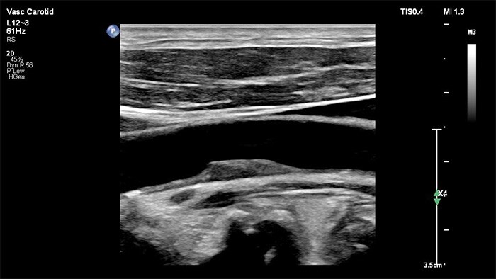 Example of an image retrieved with the XRES Pro vascular ultrasound