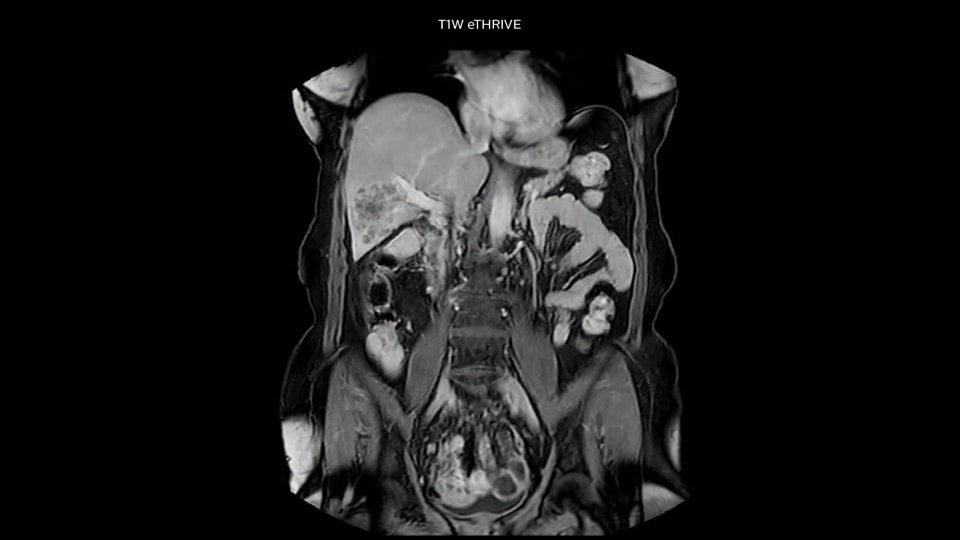 Bremen Case2 4 liver MRI 960px