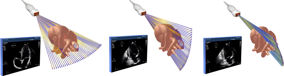 Example of a live xPlane image with xMatrix ultrasound technology