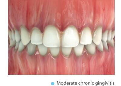 moderate-chronic-gingivitis