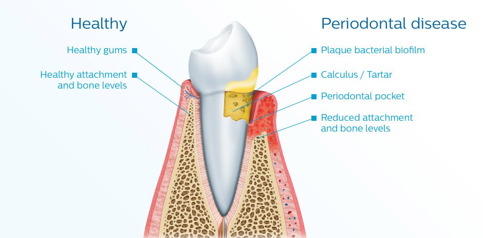 Periodontal Disease