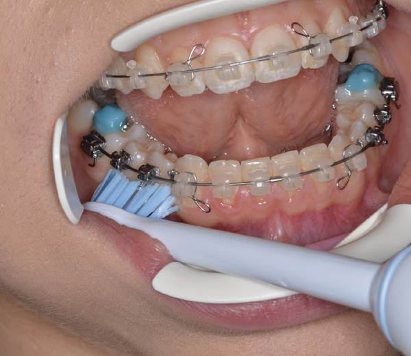 Bretele și curățare cu Sonicare 