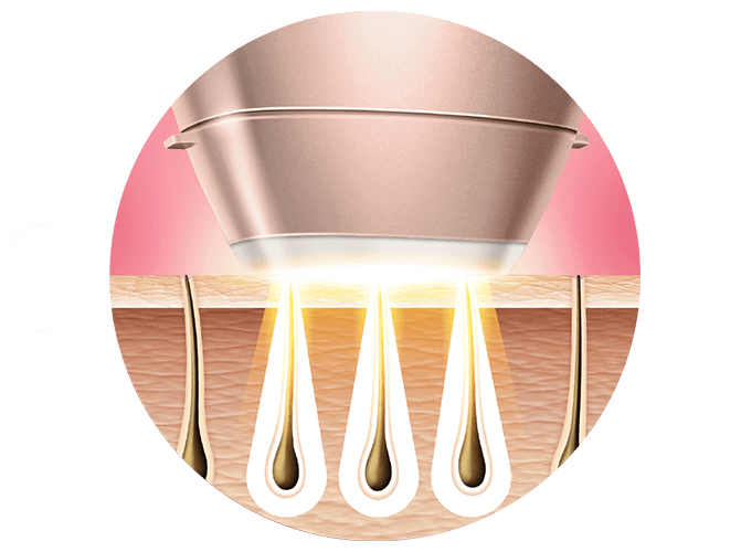 Pasul 1 - dTehnologia Intense Pulsed Light (IPL – lumină intens pulsată) utilizează pulsații de lumină caldă și delicată pe rădăcina firului de păr