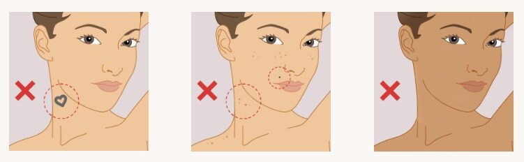 Do not use Lumea IPL on