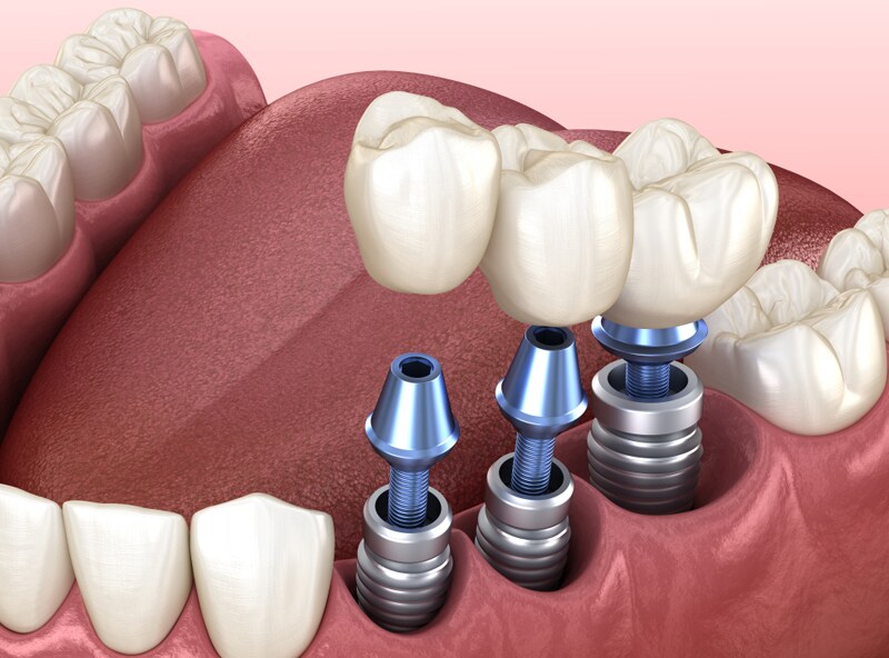 dental implant