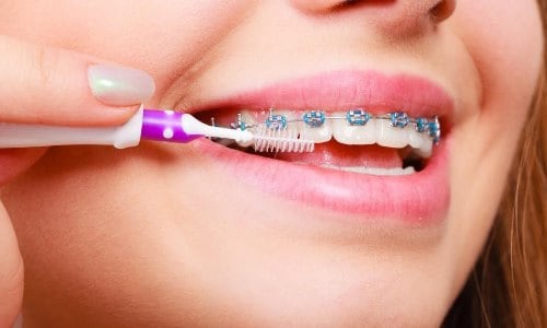 Igiena dentara atunci cand porti aparat dentar